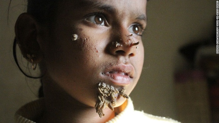 Niña de Bangladesh tiene síndrome del ‘hombre-árbol’