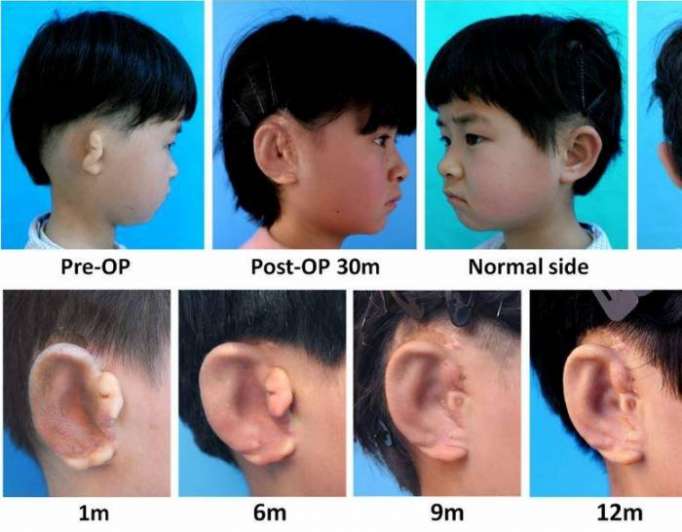 Children receive new ears grown from their own cells in world first