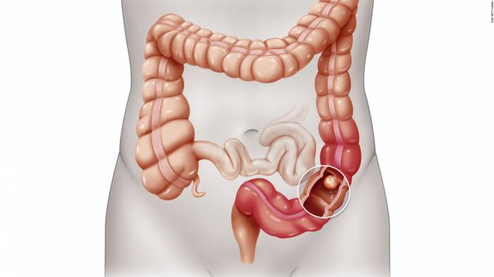 Healthy lifestyle improves survival outcomes in Colon Cancer