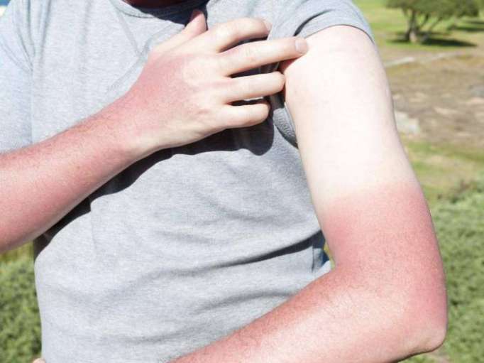 Genes controlling whether skin tans or burns discovered by scientists