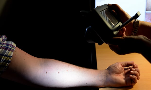 Computer learns to detect skin cancer more accurately than doctors