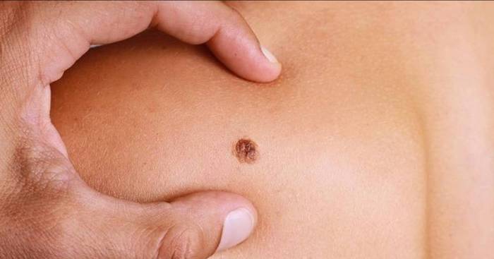 Melanoma blood test: Scientists unveil world-first research