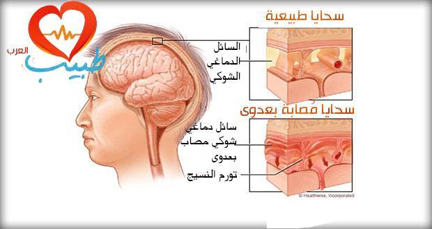 ما هو التهاب السحايا؟