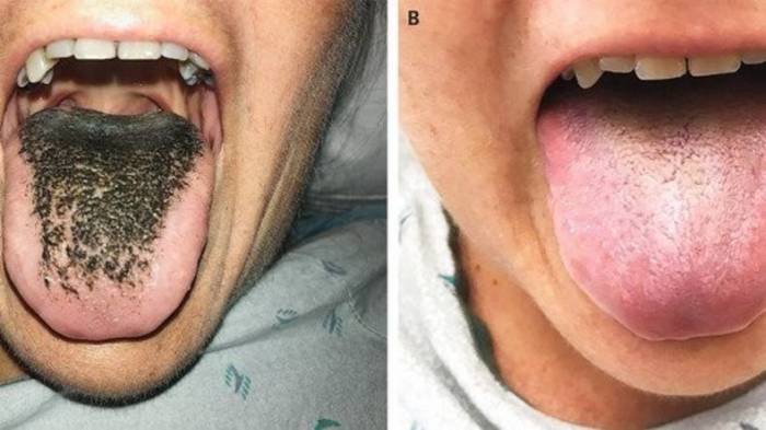 Schwarze Haarzunge: Antibiotika führen zu seltener Krankheit (Foto)