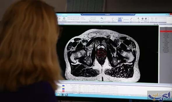 الكشف أن العلاج الإشعاعي لسرطان البروستاتا ينقذ آلاف الأرواح
