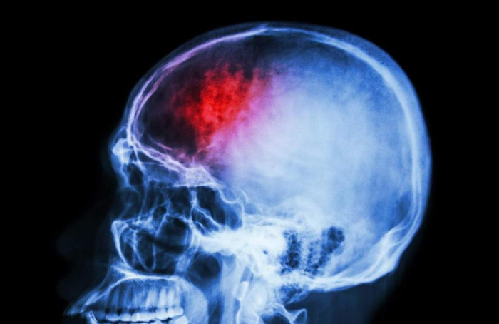 Brain implants will soon allow hackers to 