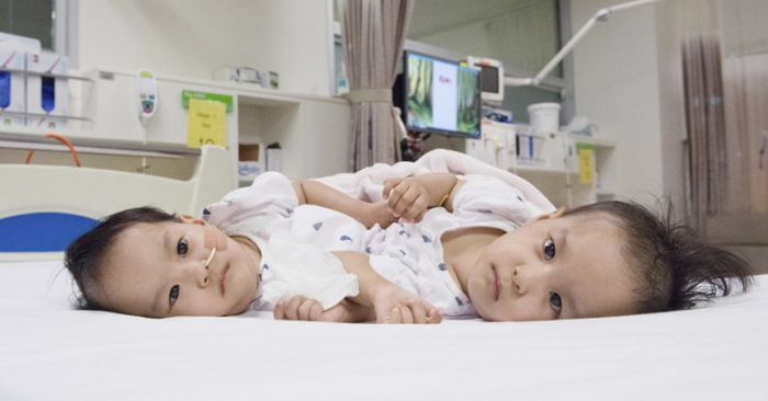 Surgeons in Australia separate conjoined girls from Bhutan