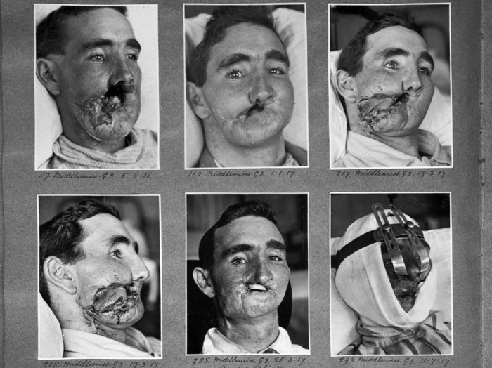 How WWI played a key role shaping plastic surgery and anaesthesia -iWONDER
