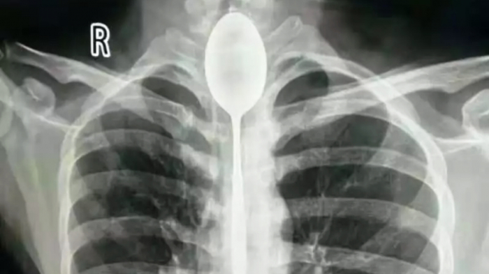 Man lives with 20cm spoon in throat for a year before seeking help -PHOTO