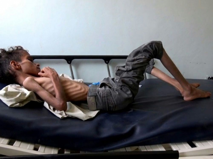 85.000 enfants morts de faim ou de maladie au Yémen, selon Save the Children
