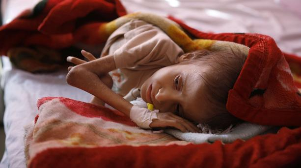 Au Yémen, Amal Hussain, petite fille devenue symbole de la famine est morte