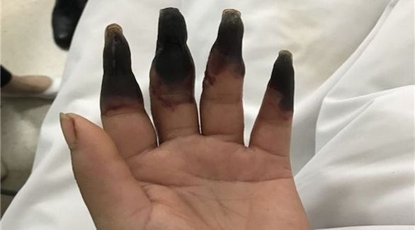 تتحول أصابعها إلى اللون الأسود بعد قيامها بأعمال المنزل