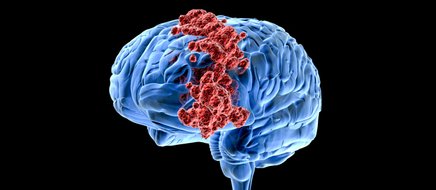 Brain cancer kills men more often & more quickly than women – study