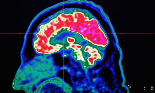 Activity sharpens even dementia-affected brains, report suggests