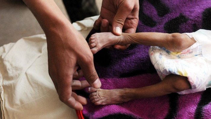 80 pct of Yemeni people need humanitarian aid: WHO
