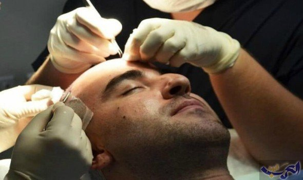تقنية طبية جديدة تسمح بتخزين بُصيلات الشعر لـ"أيام الصلع"