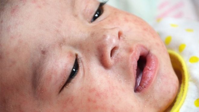 Measles outbreak declared in Philippines