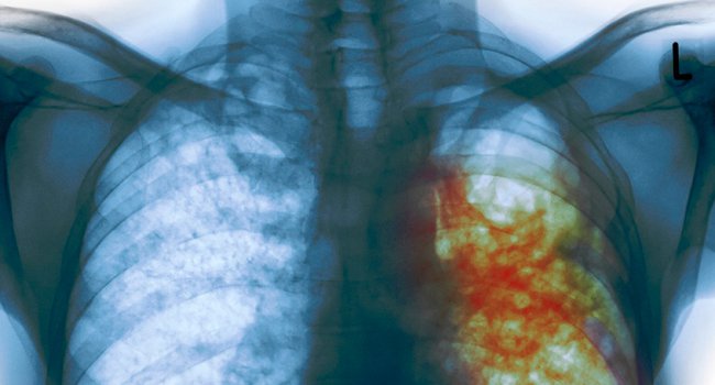 Vitamin D helps treat lethal drug-resistant TB