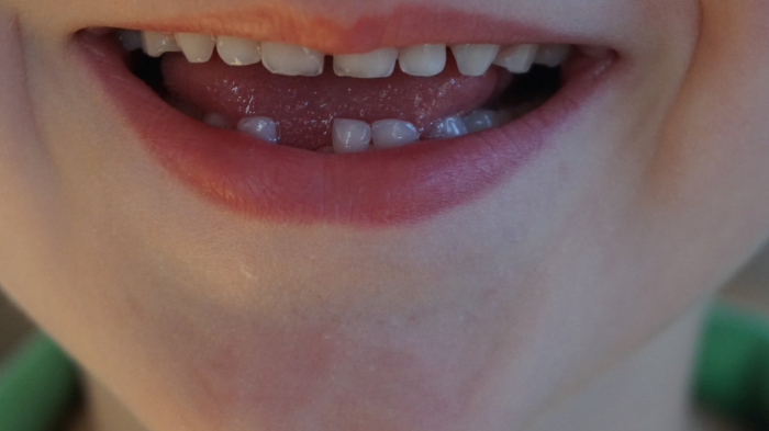 Mental health problems ‘can be diagnosed using children’s teeth’