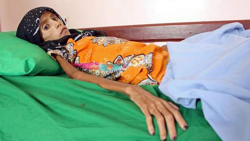 À douze ans, cette jeune Yéménite ne pèse plus que dix kilos