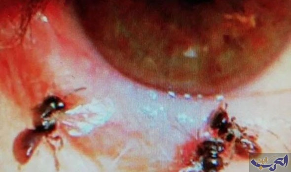 فريقٌ طبي في تايوان يُفاجَأ بوجود "4 نحلات" داخل عين شابّة