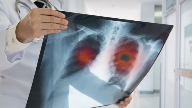 Artificial intelligence diagnoses lung cancer