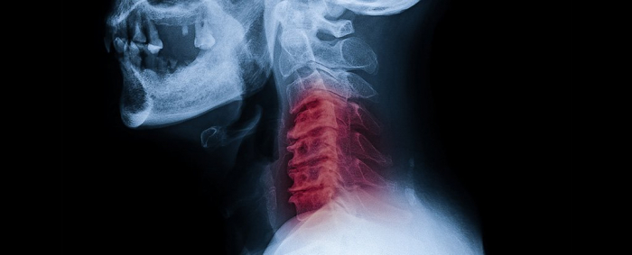 Terrifying case study shows why popping your neck could actually kill you