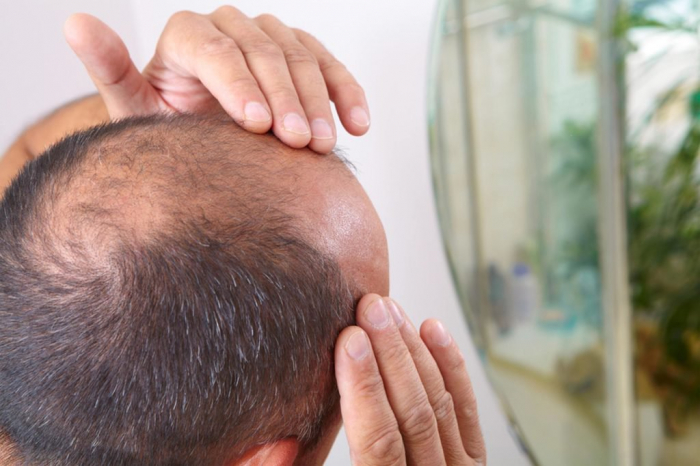 A cure for baldness is on the way, scientists claim