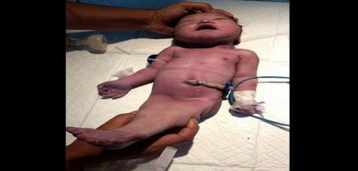 Un bébé est né avec une «queue de sirène» en Inde
