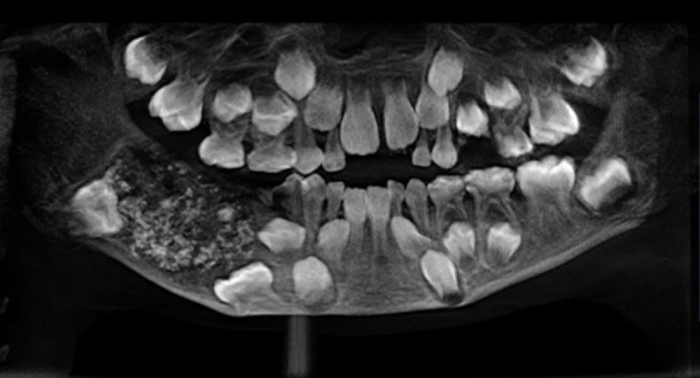   Medizinische Sensation in Indien: Ärzte entfernen Siebenjährigem 526 Zähne –   Fotos    