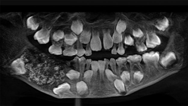 Doctors find 526 teeth in boy
