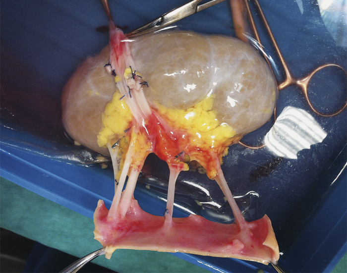  FOTO:  Doctores hallan una anomalía extremadamente rara en un riñón mientras se preparaban para trasplantarlo a una niña