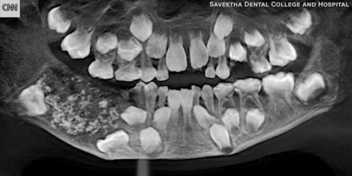 En Inde, 526 dents trouvées dans la bouche d