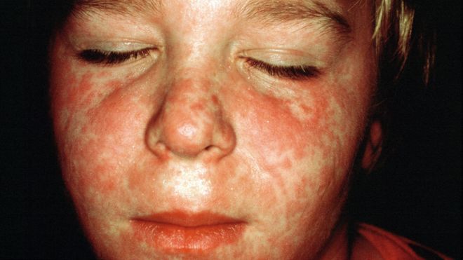 New Zealand measles outbreak rises above 1,000 cases