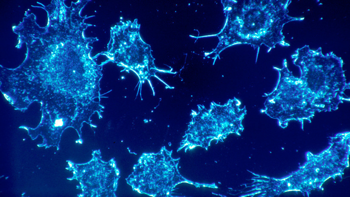 Identifican una nueva forma de combatir el cáncer resistente a la quimioterapia