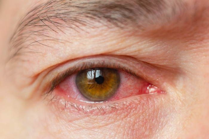 Is pink eye a symptom of Coronavirus? Eye doctors say conjunctivitis could be rare early sign