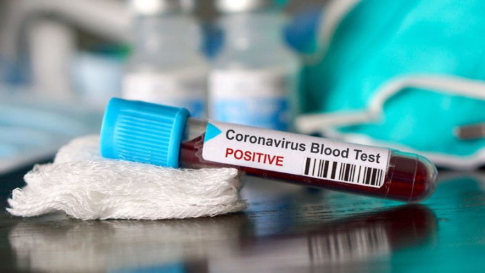   Express tests to detect coronavirus to be used in Azerbaijan  