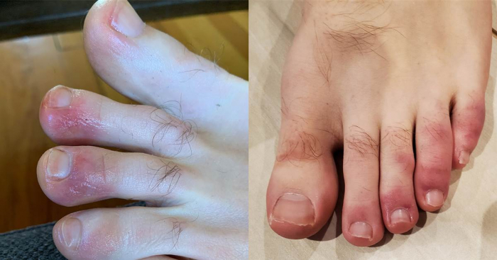 Are foot sores a new symptom of COVID-19?