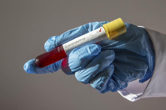 25-26 iyulda koronavirus testlərinin cavabı səhv göndərilib  