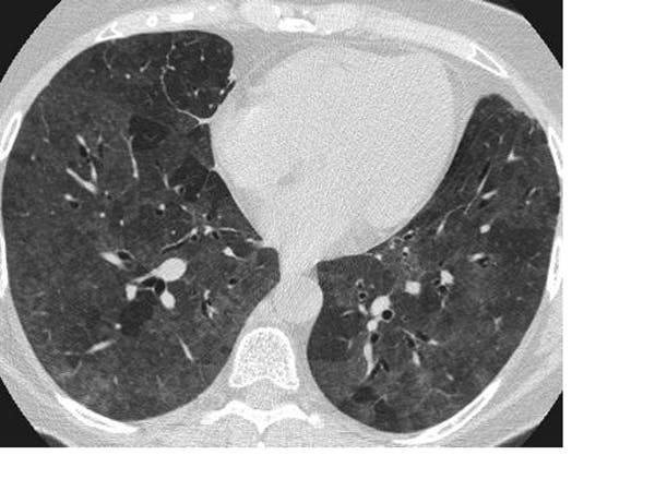   Asymptomatic COVID-19 infections can still cause   lung damage    