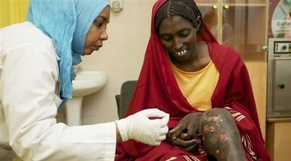 آلاف السودانيين يعانون من مرض "المايستوما"