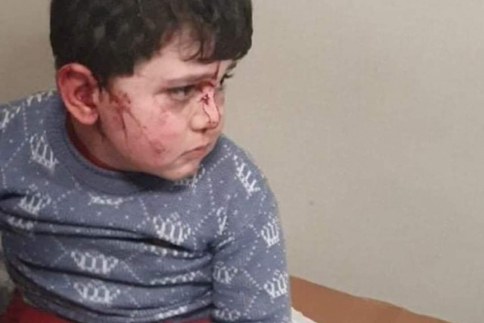    6 children injured as a result of Armenia