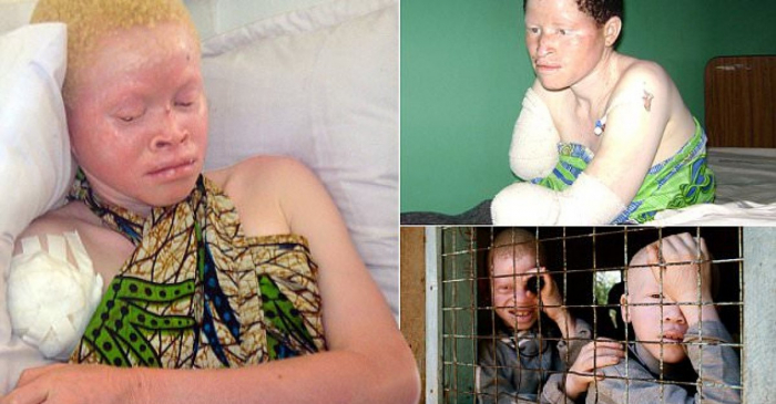 Albinizmlilərə hücumlar artıb:   Ən çox uşaqlar öldürülürlər     
   