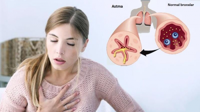  Astma xəstələrinin sayı artıb 
