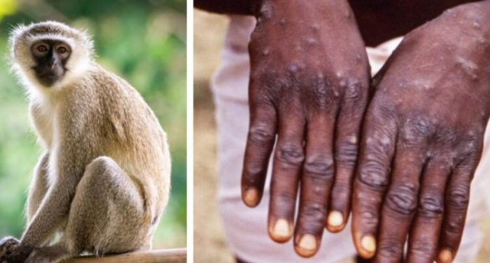   Australia records first case of human monkeypox  