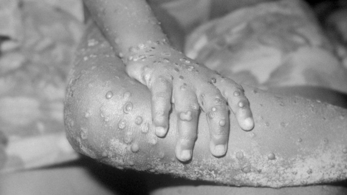   Monkeypox cases investigated in Europe, US, Canada and Australia  