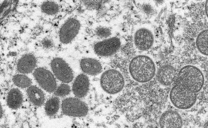 Third possible case of monkeypox found in the U.S.