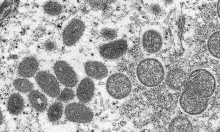 US reports rare case of monkeypox amid small outbreaks in Europe