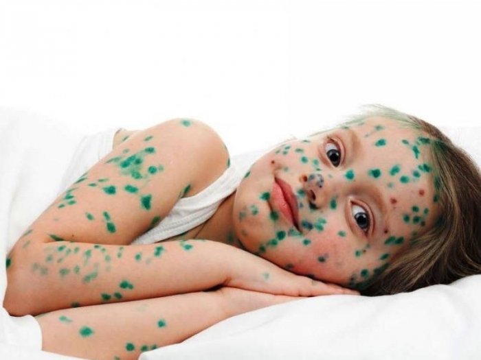   Suçiçəyi virusuna yoluxma ilə bağlı son vəziyyət necədir?    
