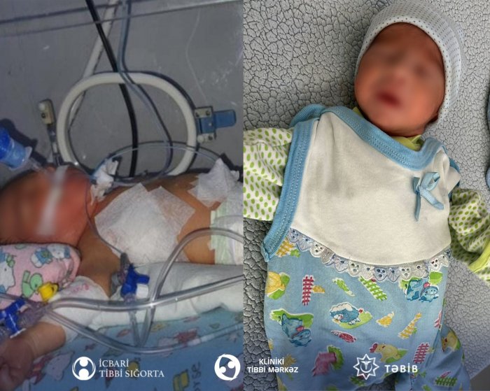    Anadangəlmə ürək qüsurla doğulan körpənin həyatı xilas olundu   